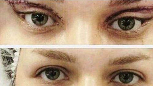 عمل زیبایی چشم گربه ای