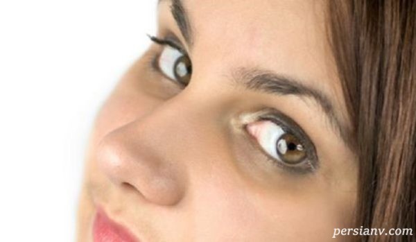 سیاهی دور چشم در بارداری