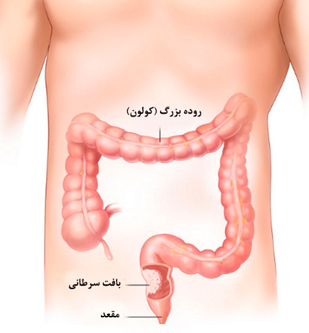 علائم سرطان روده