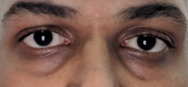 رفع گودی چشم
