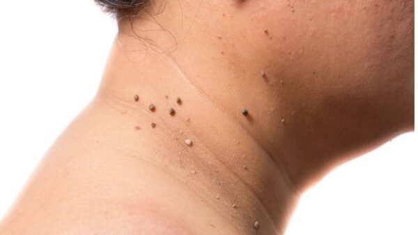 زایده گوشتی روی بدن