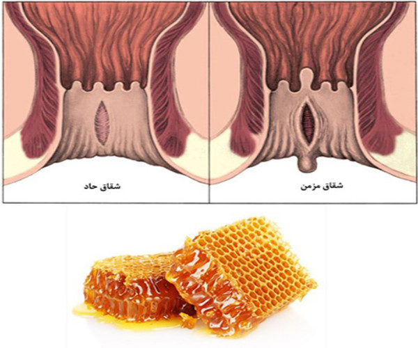 درمان بیماری بواسیر
