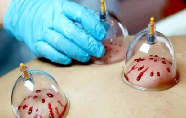تاثیر حجامت بر سلامتی بدن