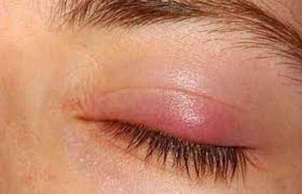 گل مژه در چشم