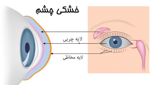 درمان خشکی چشم