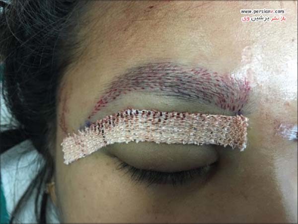 کاشت ابروی طبیعی