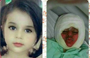 دخترک سوخته در دیگ نذری جان سپرد