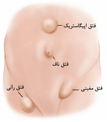 فتق ناف نوزاد