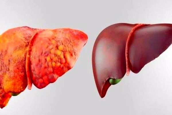 گلولهی چربی در بالای شکم