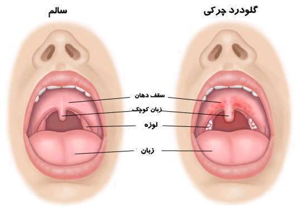 علت گلو درد علت گلو درد