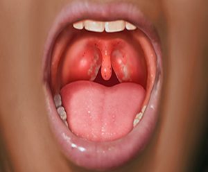 همه چیز درباره عمل لوزه ها