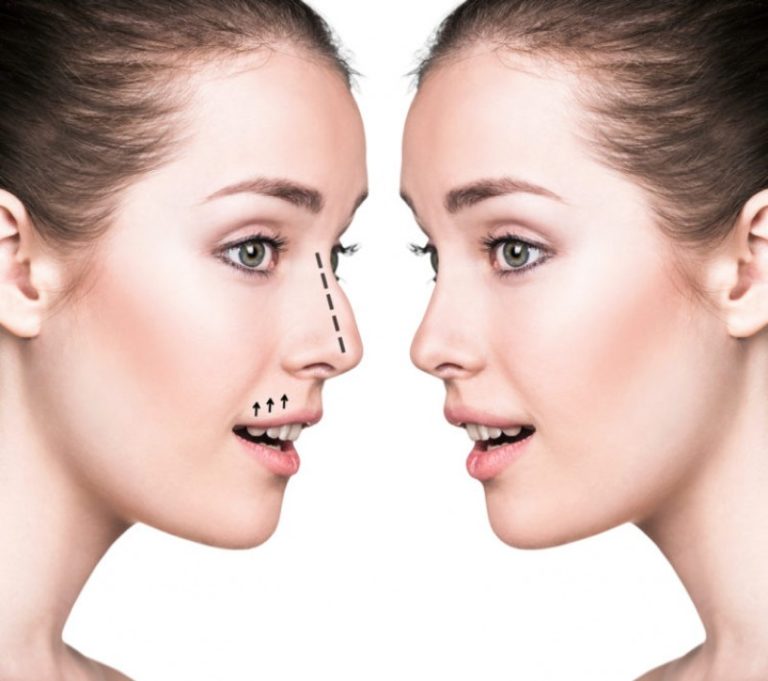 بعد از جراحی بینی چه عوارضی منتظر شماست؟