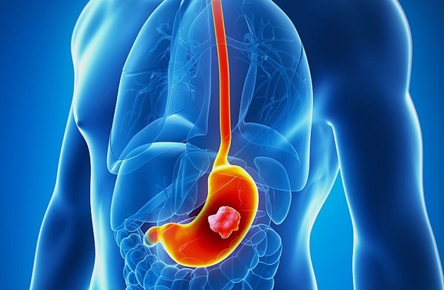 آمار سرطان های دستگاه گوارش رو به افزایش است