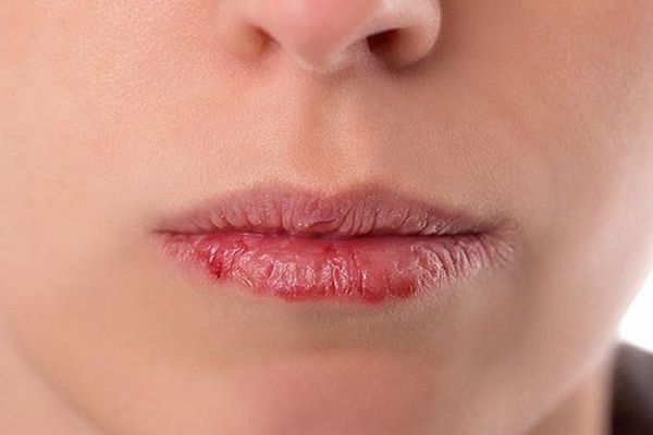 روشی برای درمان سریع تب خال