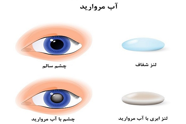 عمل جراحی آب مروارید چشم