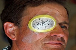 17 نکته بعد از عمل جراحی آب مروارید چشم