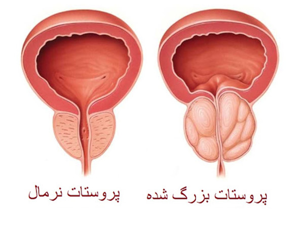 بزرگی پروستات با سرطان پروستات فرق دارد