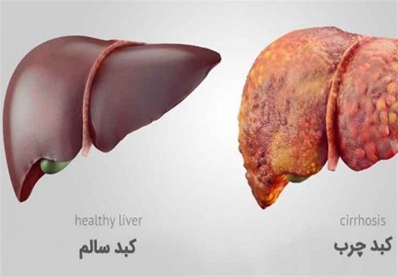 تجمع چربی در کبد میتواند به مرور زمان ایجاد التهاب و تشکیل باندهای فیبروز نماید دلایل کبد چرب چیست