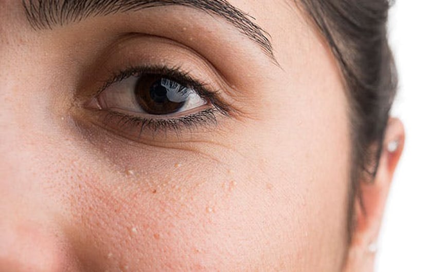 دانه های ریز روی پلک چشم دانه های ریز روی پلک چشم