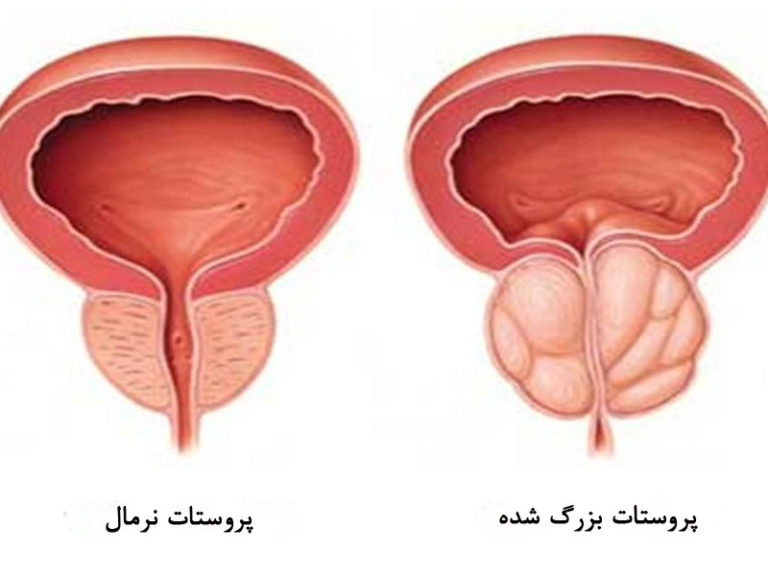علائم بیماری پروستات و عوامل مستعد کننده آن