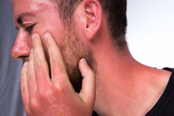 آفتاب سوختگی آفتاب سوختگی
