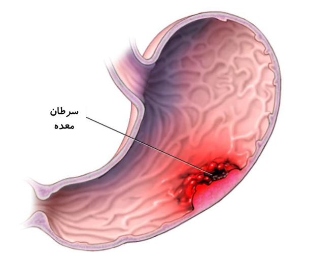 علائم و نشانه های سرطان معده را بخوانید و سرطان معده از چه زمانی آغاز میگردد؟