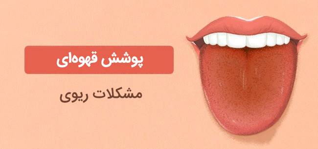 تغییر رنگ زبان