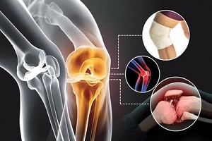 آرتروز از پیشگیری تا درمان | جلوگیری از پیشرفت آرتروز با کمک طب فیزیکی