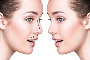 جراحی بینی یا رینو پلاستی چیست و برای چه کسانی مناسب است