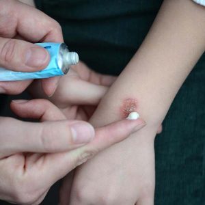 چطور زخم و اسکار سوختگی را از بین ببریم