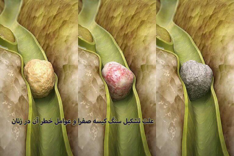سنگ کیسه صفرا چگونه ایجاد می‌شود و چرا زنان بیشتر در معرض خطر هستند؟