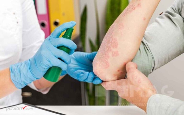 علت شیوع زونا در فصل بهار | درمان از دیدگاه طب سنتی + علائم و راهکارها