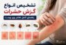 تشخیص انواع گزش حشرات