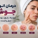 راهنمای کامل انواع جوش صورت ؛ از سرسیاه تا کیست را بشناسید! راهنمای کامل انواع جوش صورت ؛ از سرسیاه تا کیست را بشناسید!