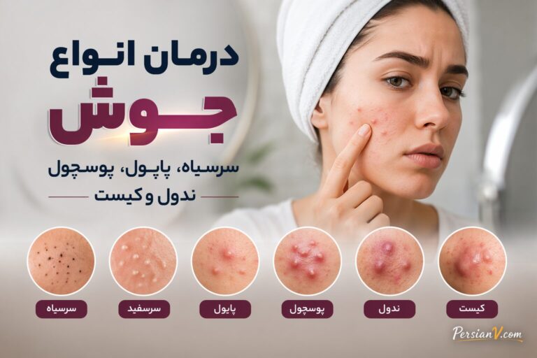 راهنمای کامل انواع جوش صورت ؛ از سرسیاه تا کیست را بشناسید!