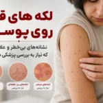لکه‌های قرمز روی پوست ؛ کدام بی‌خطرند و چه زمانی باید جدی گرفته شوند؟