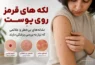 لکه های قرمز روی پوست