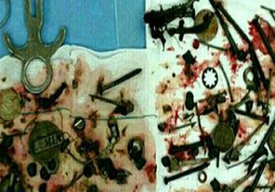 خارج شدن قطعه فلزی از شکم بیمار
