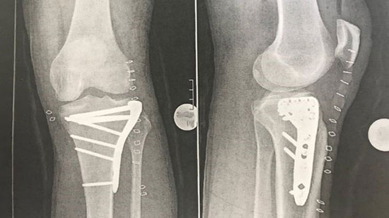 مجری تخت گاز پس از تصادف