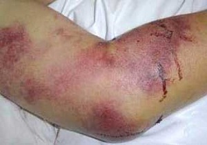 مبارزه با تب کریمه کنگو در ۵ استان تشدید شد!