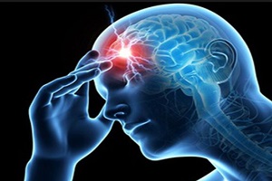 10 عامل سکته مغزی در ایران و جهان اعلام شد