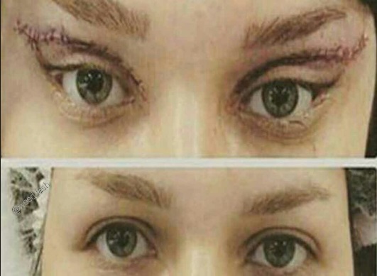 جراحی گوش الاغی