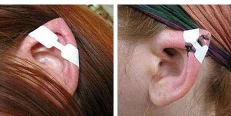 عمل زیبایی گوش الاغی عمل زیبایی چشم گربه ای