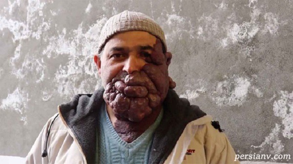 مرد 47ساله با این چهره وحشتناک به دنبال عشق واقعی