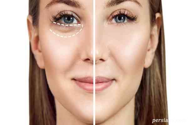 5 روش پوشاندن سیاهی و پف زیرچشم بدون آرایش+ مطلب مفید