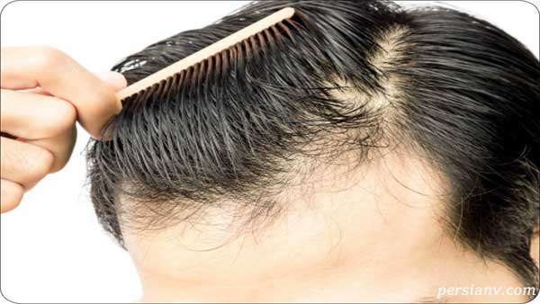 علت های ریزش مو جلوگیری از ریزش مو