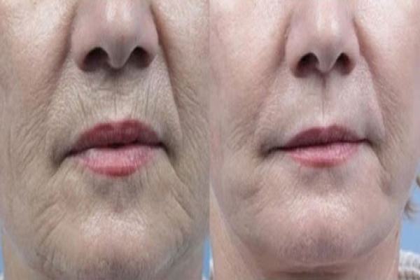 ماسک ضد چروک طبیعی