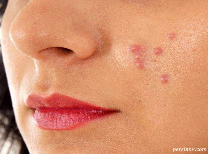 با این ماسک ها به راحتی در خانه جای جوش روی صورت خود را از بین ببرید + عکس