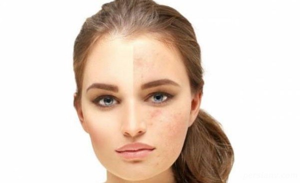 از بین بردن لک های پوستی با طب سنتی از بین بردن لک های پوستی