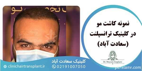 کاشت مو به روش HRT | هزینه، مزایا، مراحل